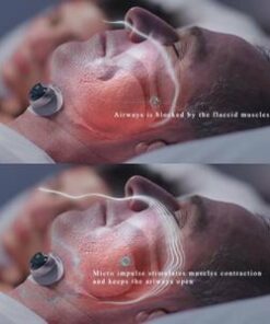 v5antisnoringdevice 300x.jpg